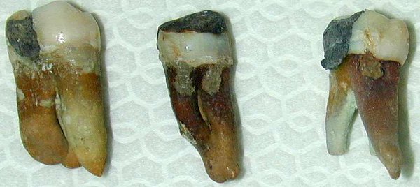 denti devitalizzati